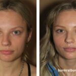 buccal fat removal